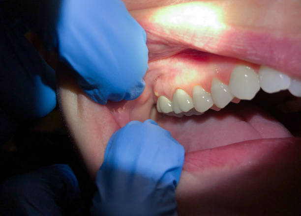 Best Emergency Wisdom Teeth Removal in Rancho Cumonga, CA