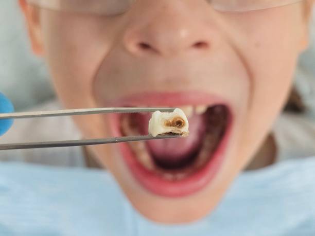 Best Emergency Dental Care for Broken or Chipped Teeth in Rancho Cumonga, CA