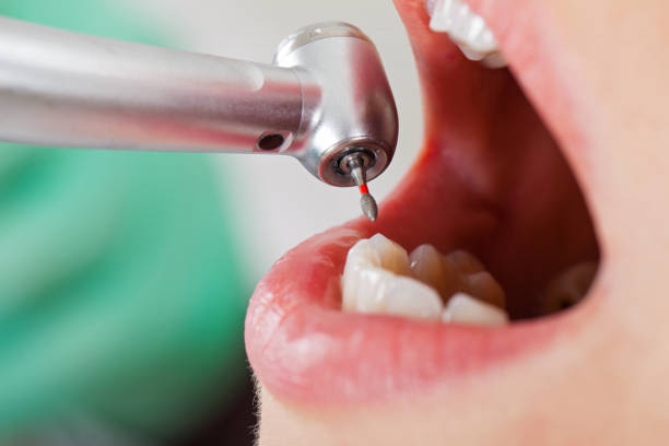 Best Urgent Care for Lost Fillings or Crowns in Rancho Cumonga, CA